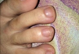 「脚趾甲发白是灰指甲吗」脚趾甲里面有白灰是灰指甲吗