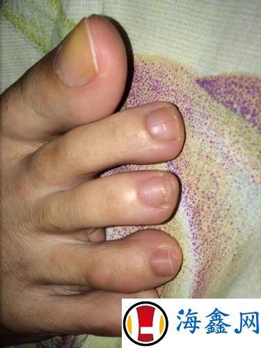 脚趾甲发白是灰指甲吗