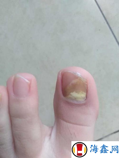灰指甲引起的脚趾甲发白怎么治疗